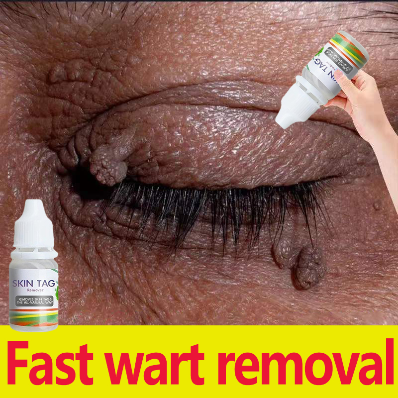 Hot Salemole Remover Warts Remover Skin Tags Remover Painless