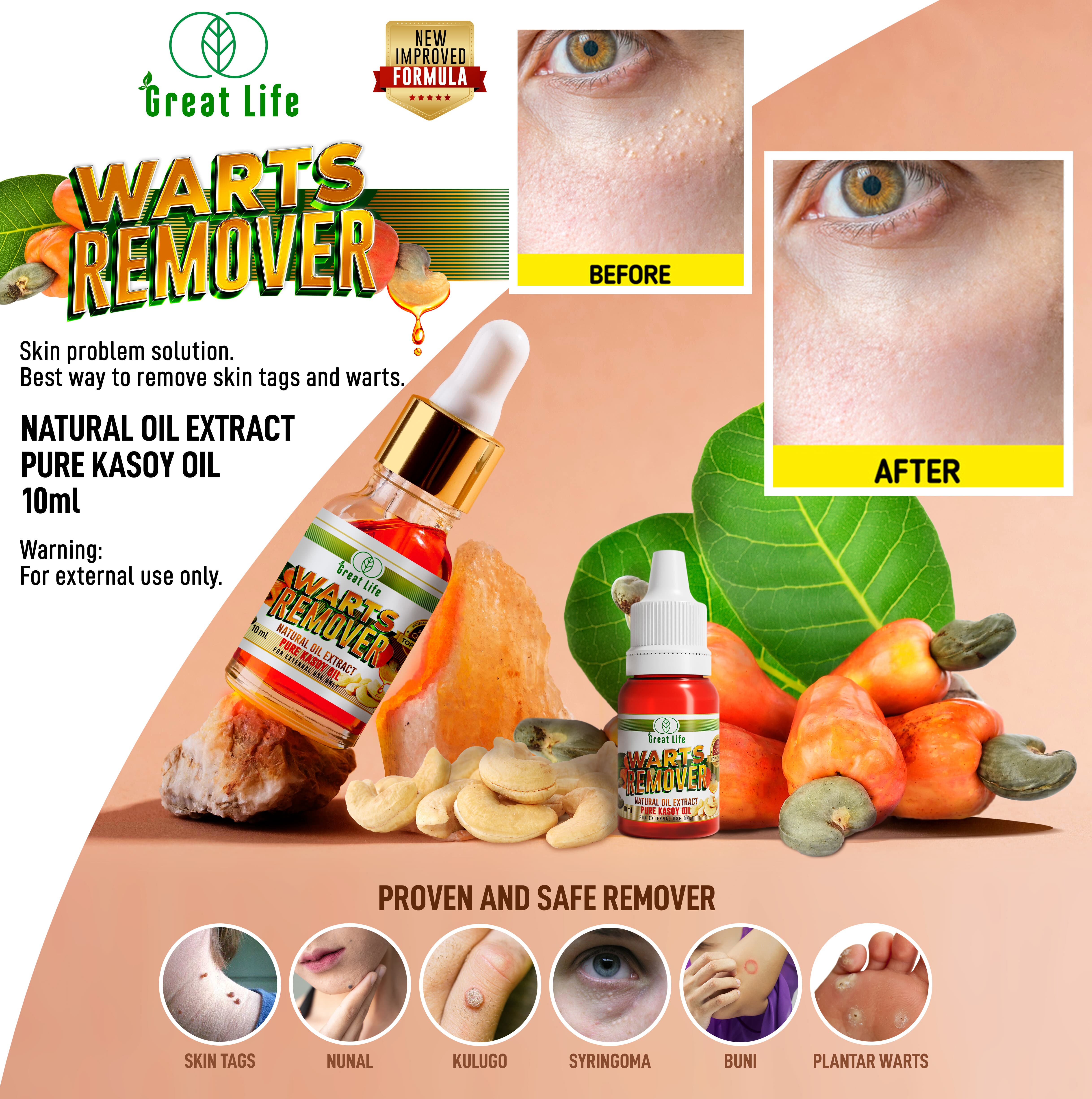 Warts Remover Pure Kasoy Oil Mole Skin Tag Remover By Great Lifes