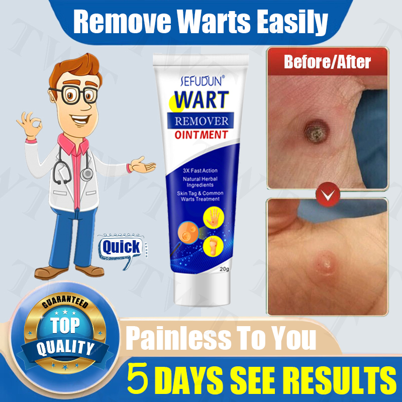 Effectively Remove Common Warts Flat Warts Filamentous Warts And Sharp