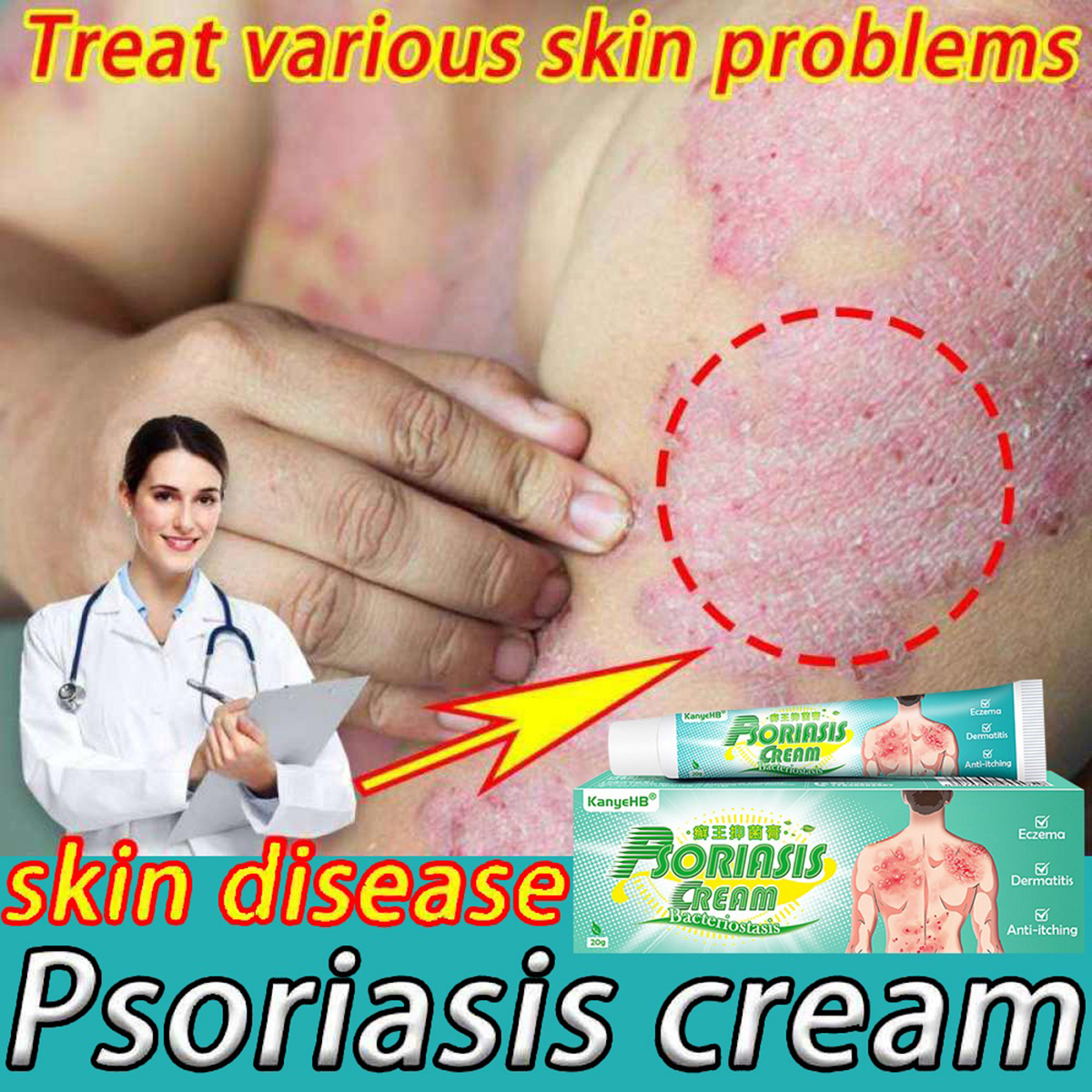 Psoriasis Cream Dermatitis Eczematoid Eczema Pruritus Ointment