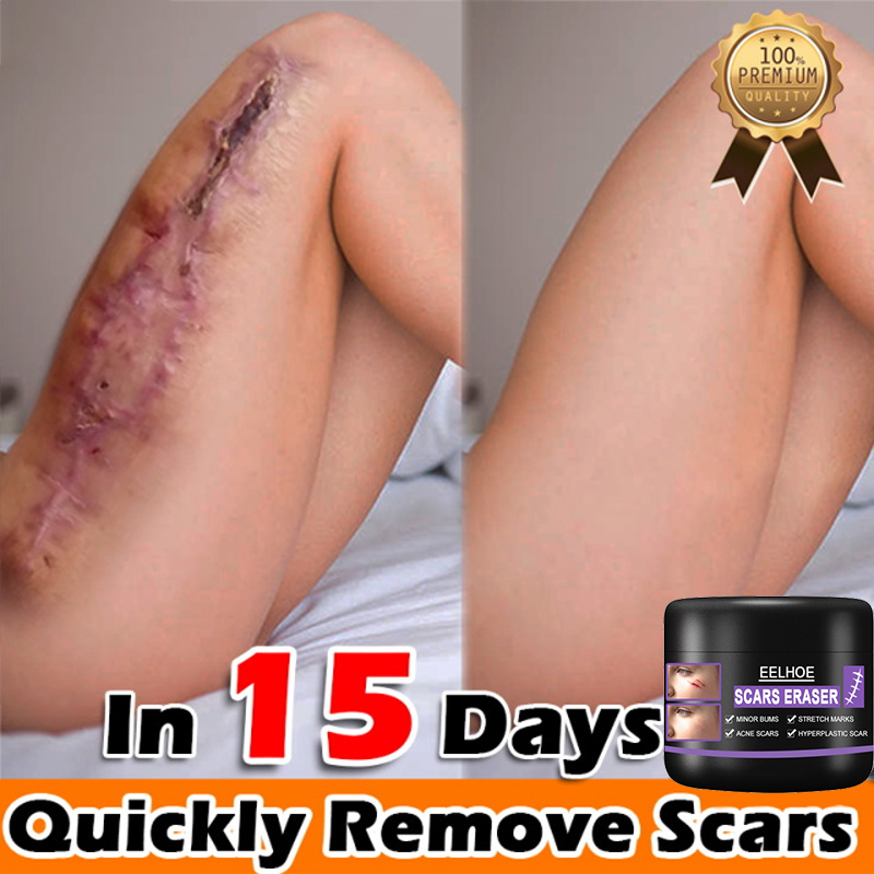 Cod Eelhoe Scar Remover G Peklat Remover Cream Original Acne Scar