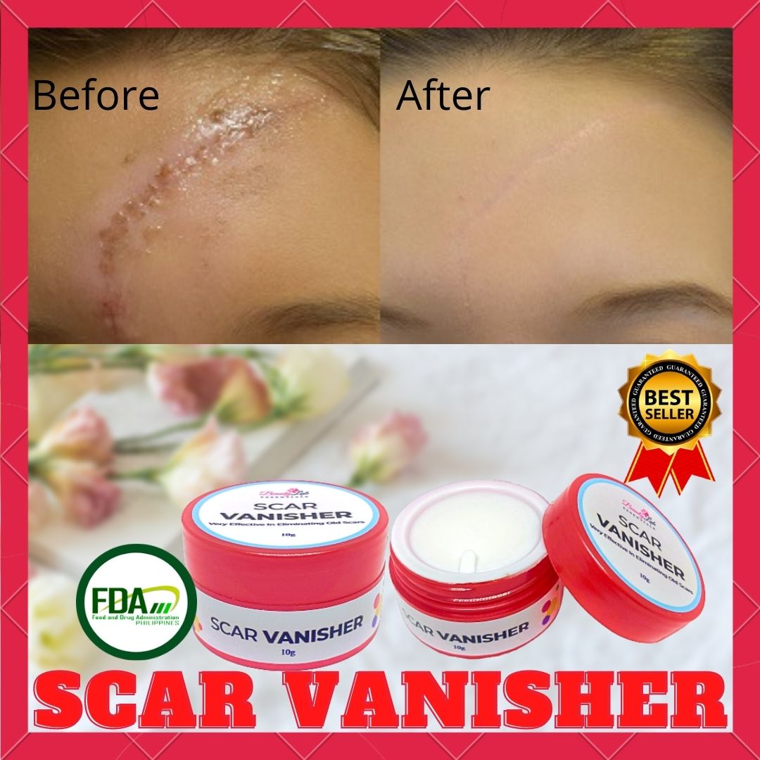 Beauty Lab Essentials Scar Vanisher G For Stretch Marks Removal Acne