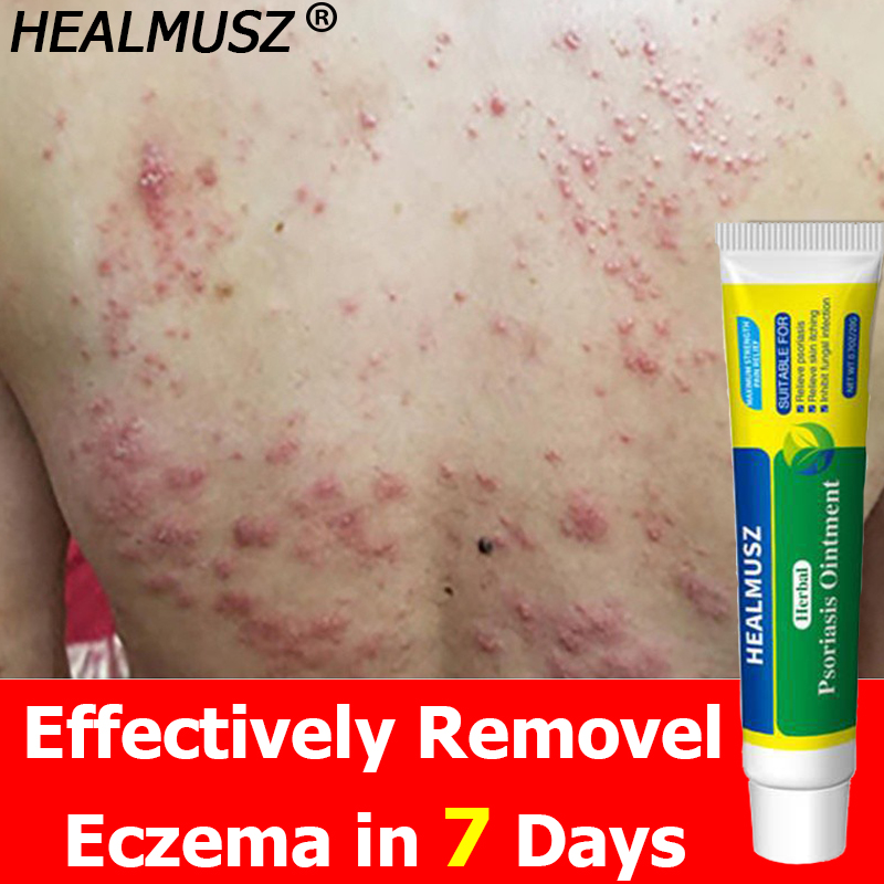 Seven Days Removal HEALMUSZ Skin Ointment Herbal Psoriasis Sa Kati Kati