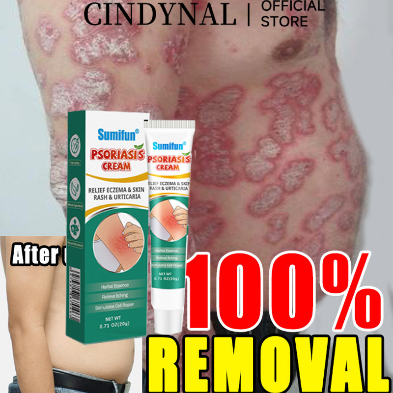 CINDYNAL RIGINAL Effective Eczema Treatment Herbal Antibacterial