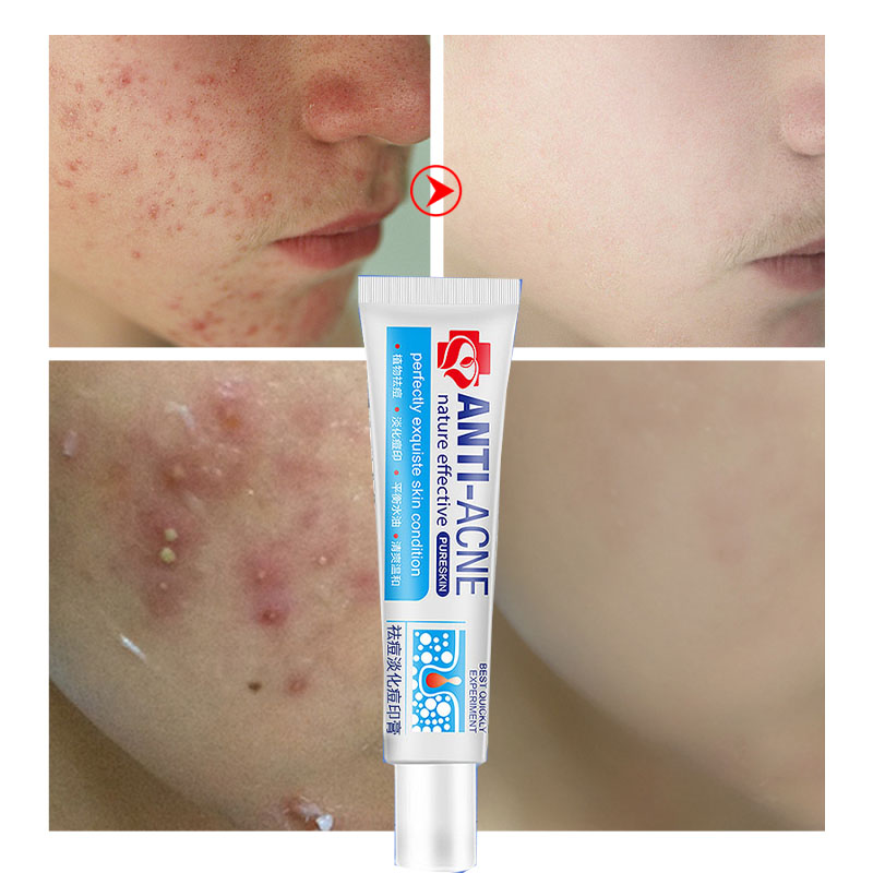 Ready Stockremove Pimples Quickly Pimple Remover Acne Cream Acne Scar