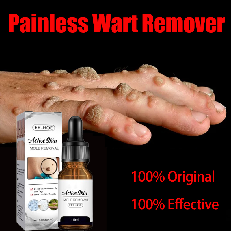 Natures Warts Remover Warts Remover Original Mole And Warts Remover