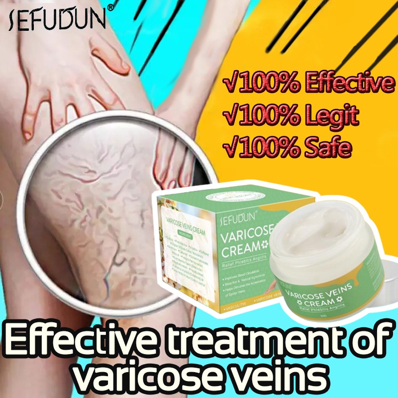 Sefudun Varicose Vein Cream Varicose Vein Treatment Cream Effective