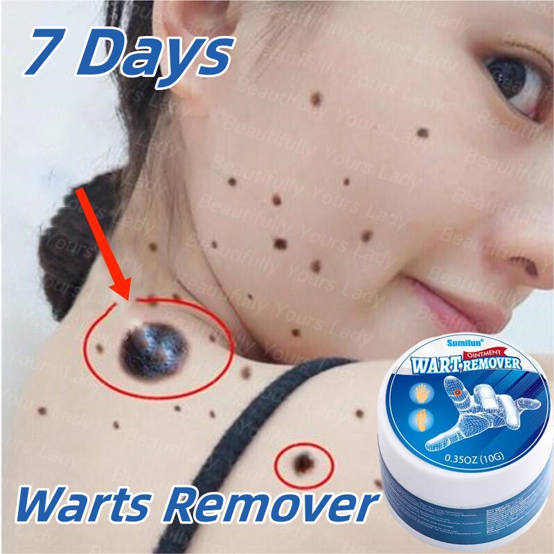 Warts Remover Original Mole And Warts Remover Kasoy Oil Warts Remover