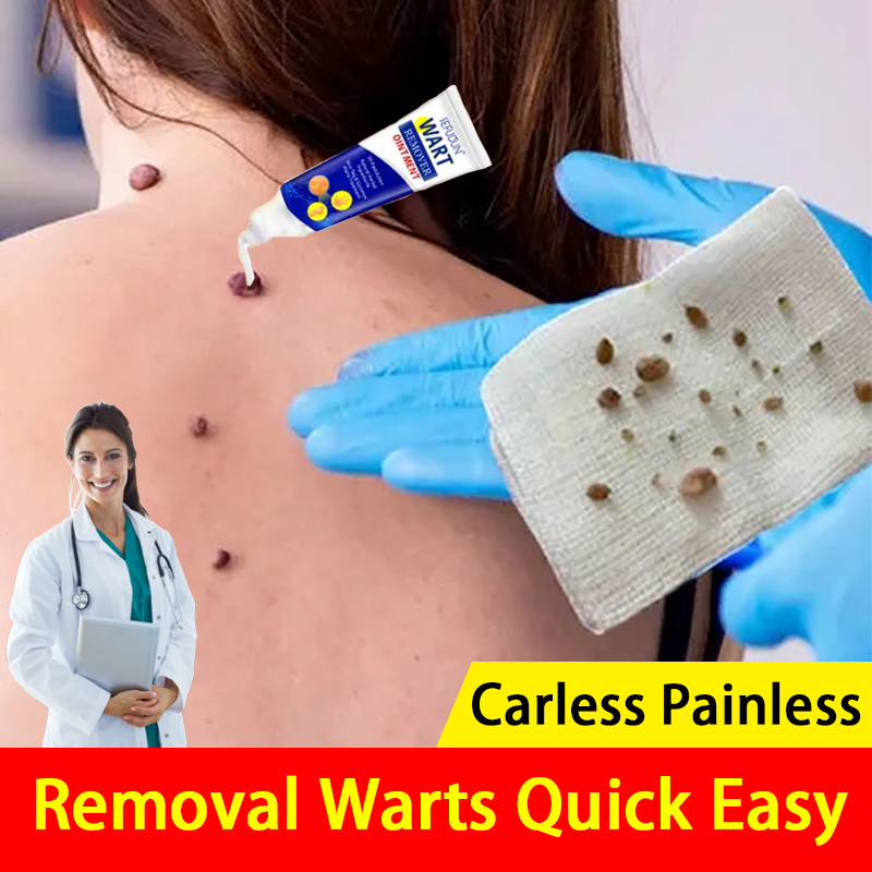 Easily And Quickly Warts Remover Original Cream Warts Magic 20g Remover