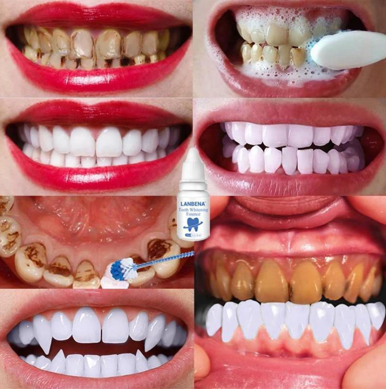 LANBENA TRẮNG RĂNG Teeth Clean Spot Cleaning LÀM SẠCH RĂNG Teeth Whitening TRẮNG RĂNG Teeth White Intensive Whitening Treatment cao cấp