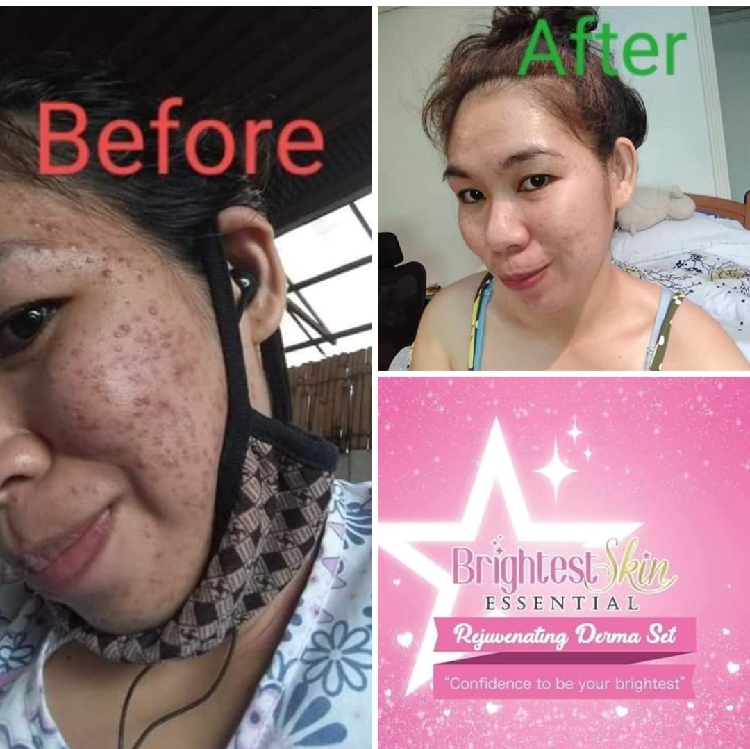 Sets Of Brightest Skin Essentials Rejuvenating Derma Set Confidence To Be Your Brightest Whitening Anti Acne Beautiful Skin Brightest Skin Rejuvenating Set For Acne Marks Pimple Marks