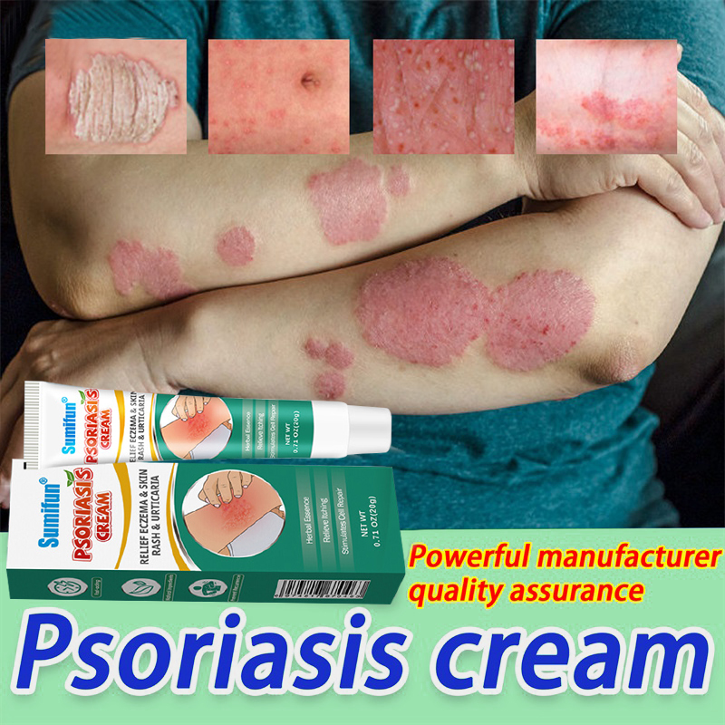 3Days Effective Psoriasis Ointment Psoriasis Eczema Cream Psoriasis ...