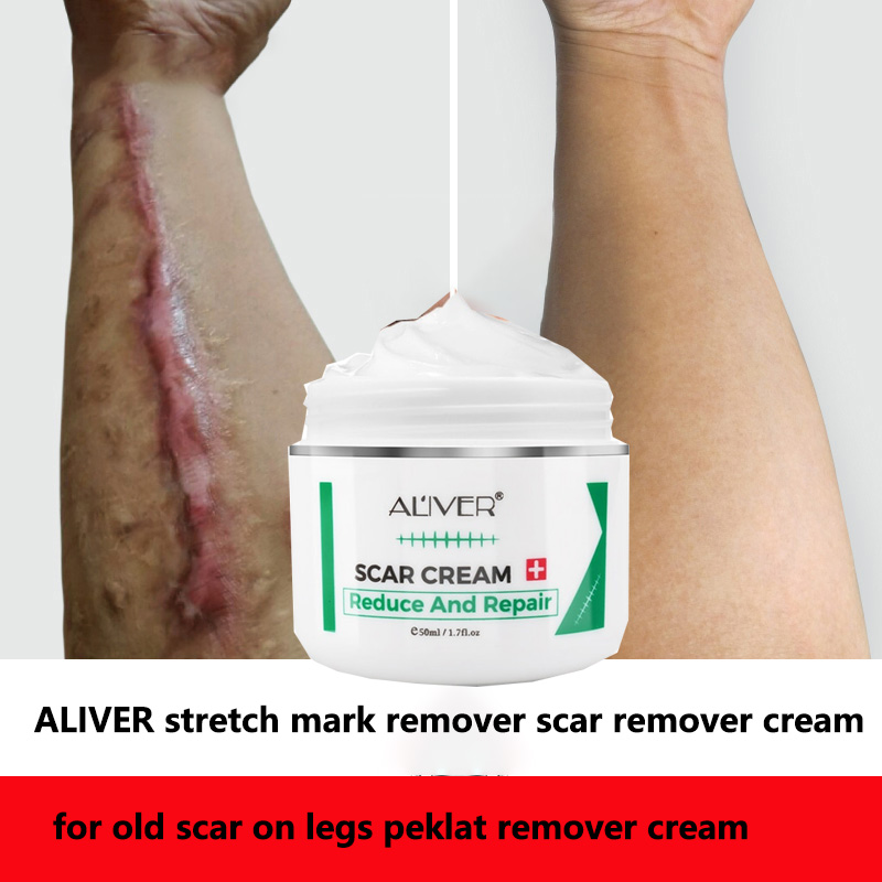 Aliver Scar Remover for Old Scar on Leg Stretch Mark Remover Acne Scar ...