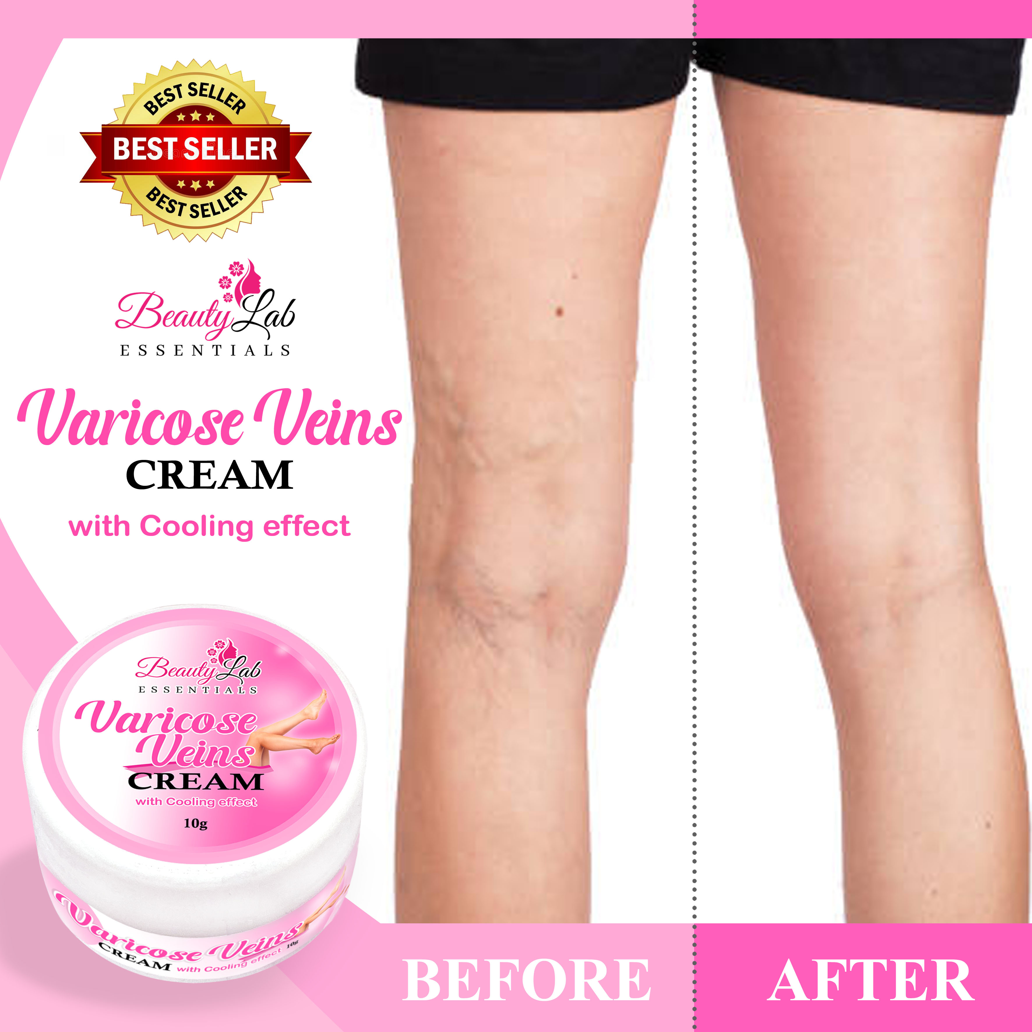 2Types Varicose Vein Ointment Phlebitis Vasculitis Treatment Cream