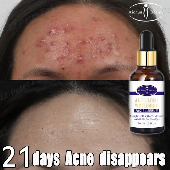 acne treatment essence cream