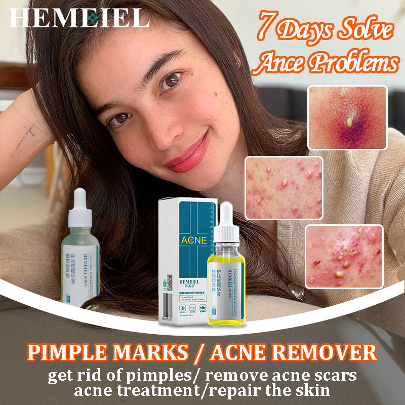 HEMEIEL Pimple Marks Acne Remover | Back Acne Treatment Serum Set