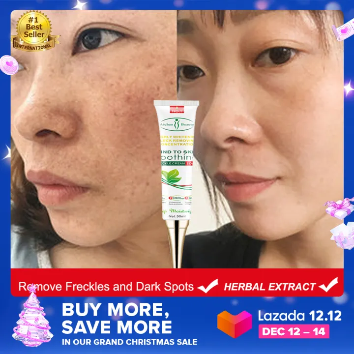 melasma removal cream