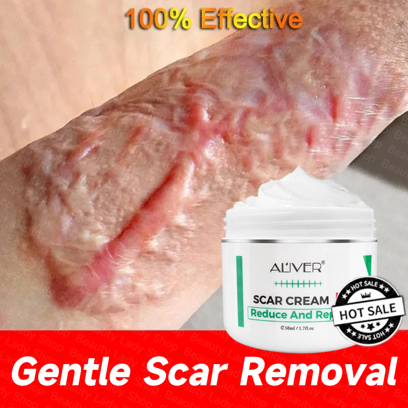 100 Effective Aliver Peklat Remover Cream Old Scars scar treatment