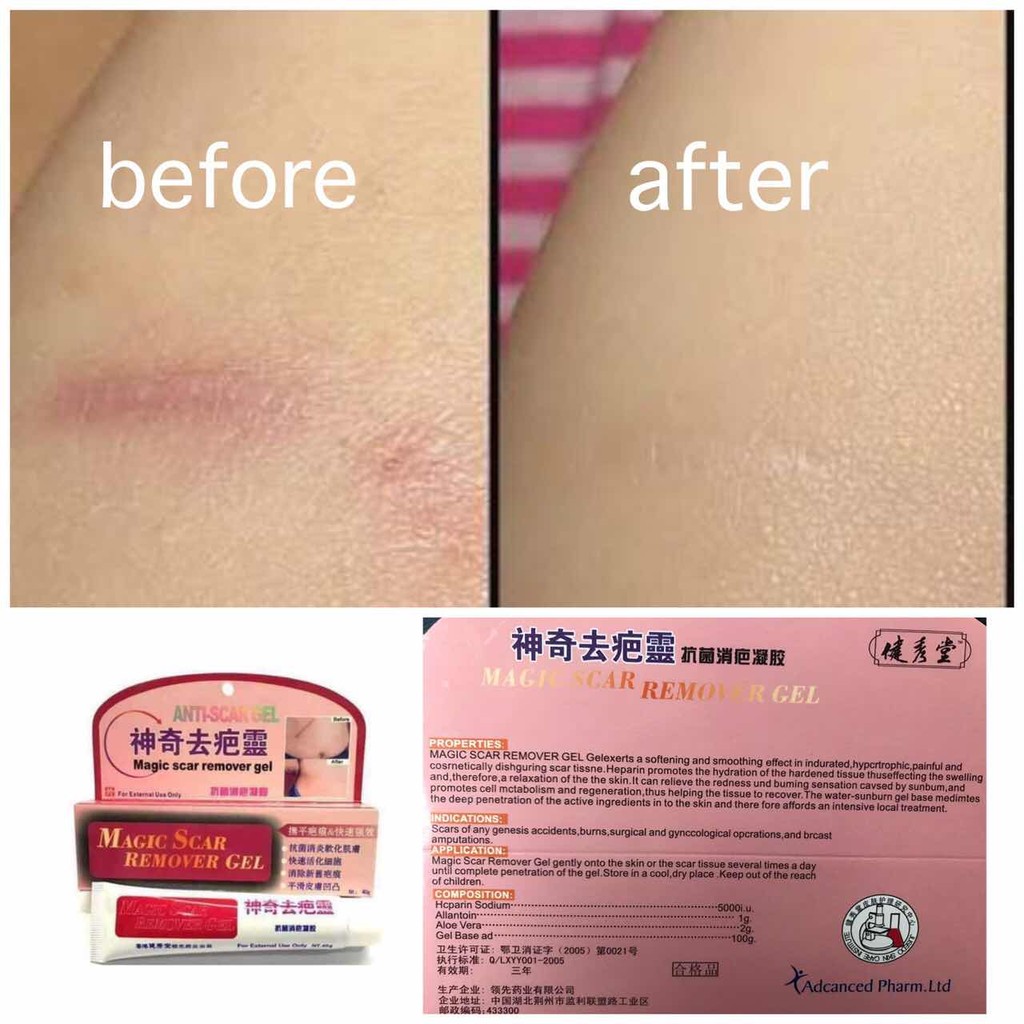 lanbena scar removal watsons