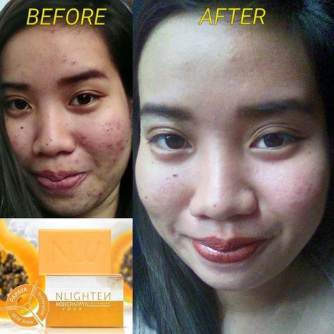 NLIGHTEN KOJIC PAPAYA with GLUTATHIONE & NLIGHTEN PREMIUM SOAP. 3 BARS |  Lazada PH