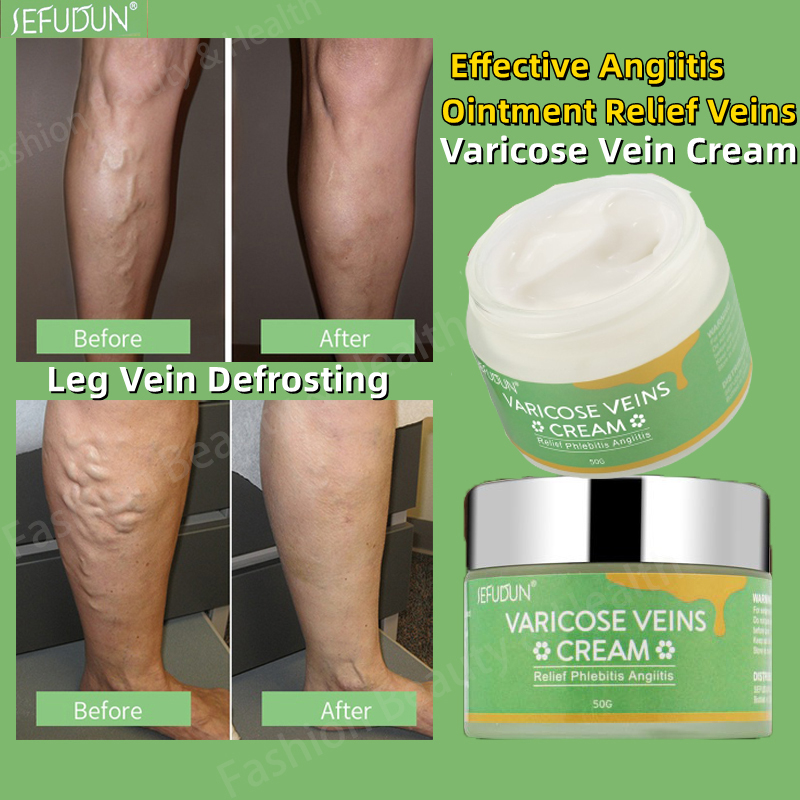 SEFUDUN Varicose Vein Treatment Cream Spider Vein Pain Varicosity Effective Varicose Healing