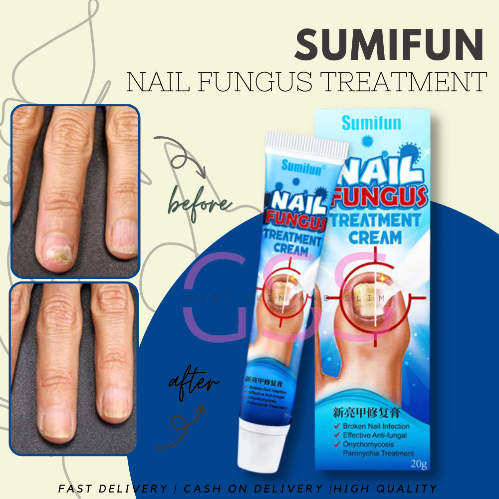 2Types Fungal Nail Cream Toe Fungus Paronychia Antibacterial Liquid  Onychomycosis Repair Medical Ointment Anti Infection Plaster - AliExpress