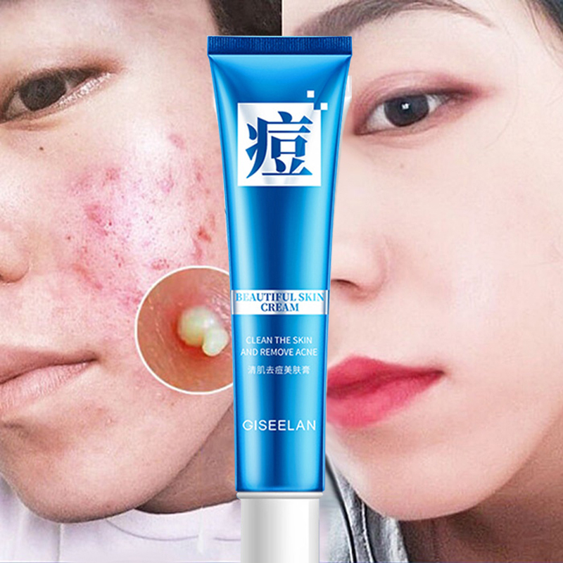 Acne cream acne scar treatment serum acne scar remover 20g Quickly and safely remove acne and