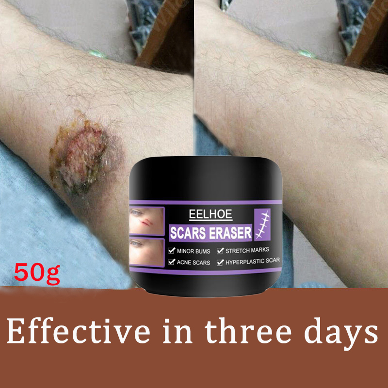 EELHOE scar repair cream 50g Scar Remover for Old Scar on Leg Scar Gel