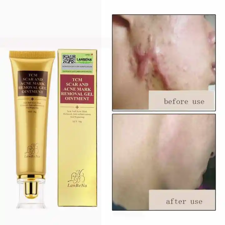 stretch marks on legs removal cream