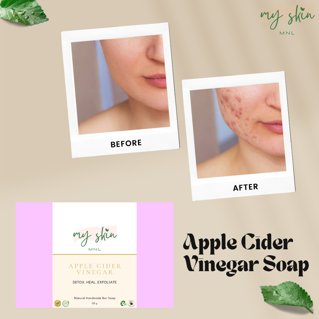 My Skin Apple Cider Vinegar Soap, Anti Acne ACV Soap Bar, Pimples