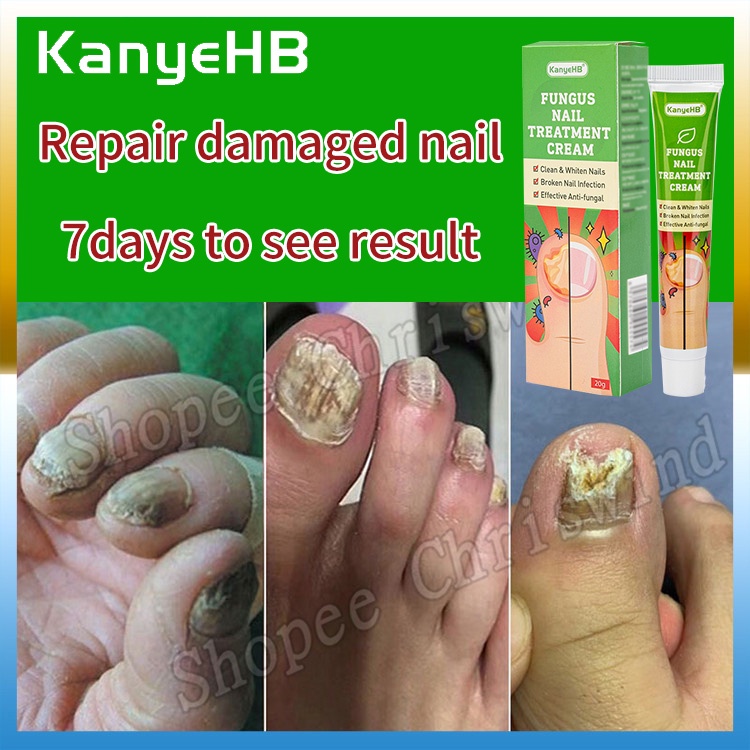 Hand Foot Nail Care Onychomycosis fungus treatment cream strip cushion