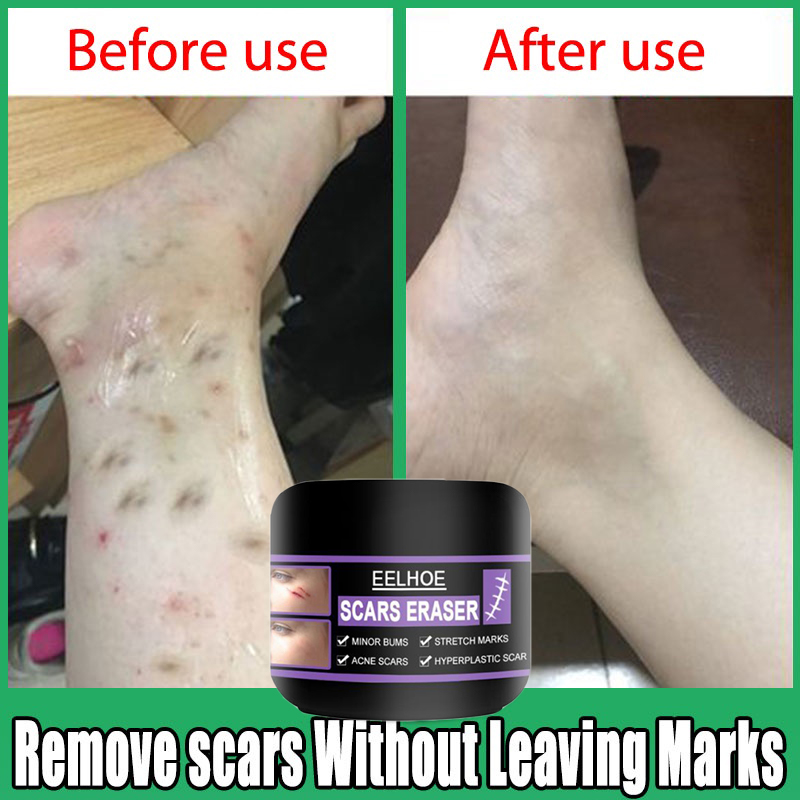 Scar Remover for Old Scar On Leg scars removal cream old scars cream