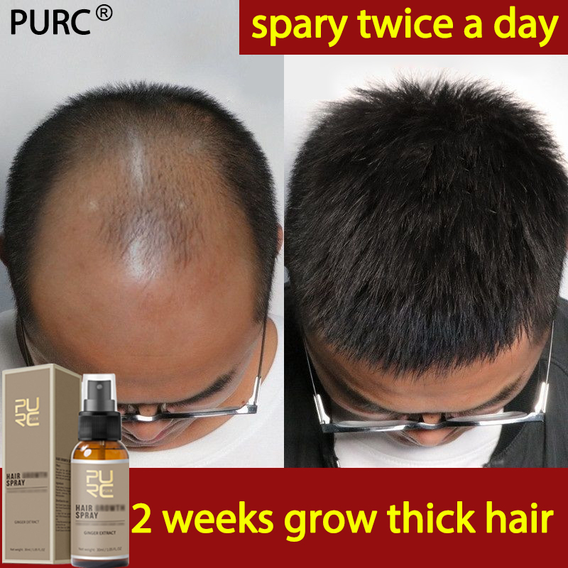 Gambar PURC Hair Growth Spray original 30ml Strengthen The Nutrition Of Hair Root Accelerate Hair Growth Prevent Baldness Effectively hair grower for men original purc hair growth serum original purc hair growth oil purc hair grower Hair Grower for Men and Women