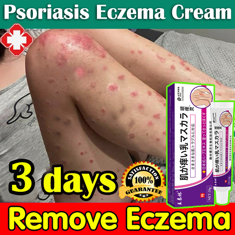 👍Effective in 3 days👍Japan eczema treatment cream 20g psoriasis