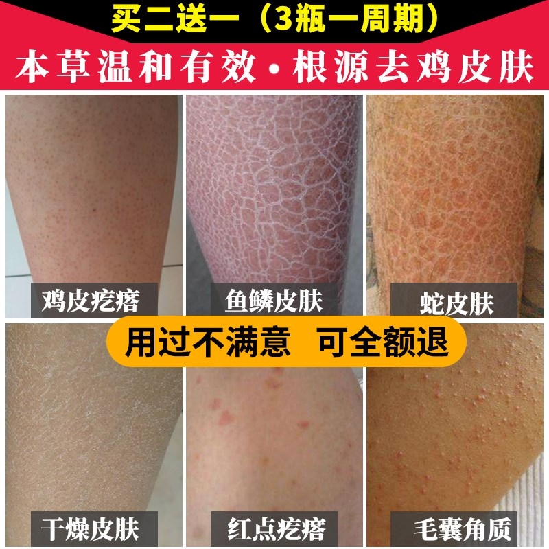 Chicken skin hair follicle keratin pimple keratosis snake skin fish