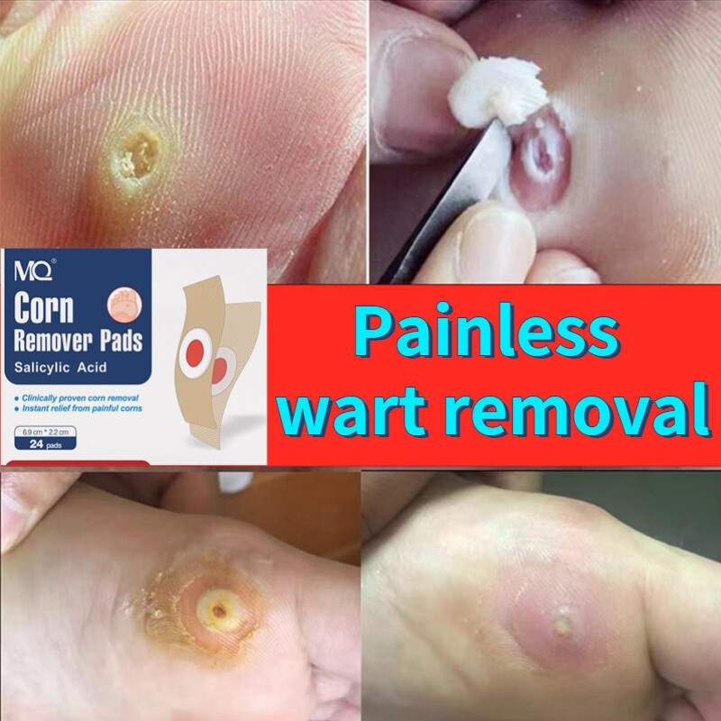 3 Days Remove Corns Warts 24PCS Box Warts Remover Patch Pain Relief 3-days-remove-corns-warts-24pcs-box-warts-remover-patch-pain-relief