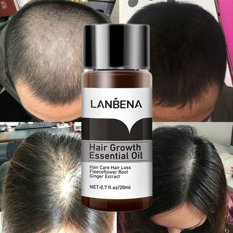 Lanbena Hair Growth Essential Oil Hair Loss Treatment Prevent Baldness Hair Grower For Men And 5437