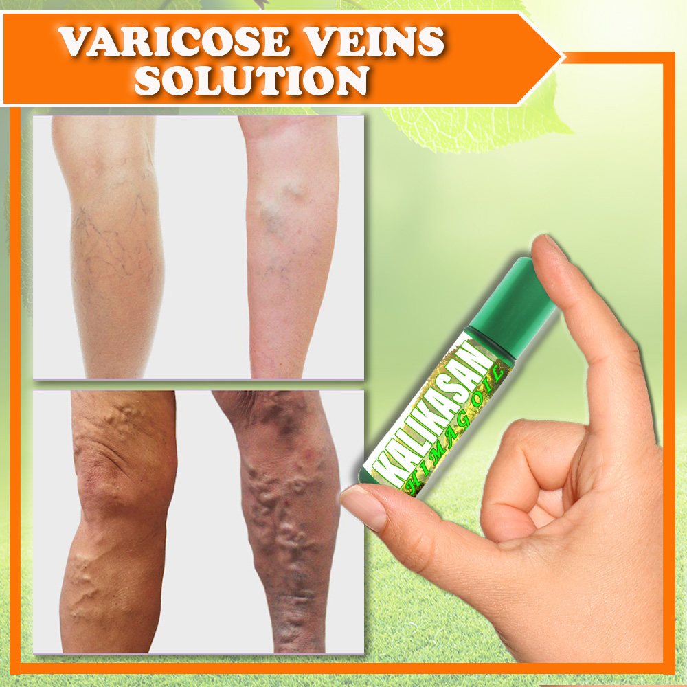 KALIKASAN Himag Oil varicose and spider veins remover , spider vein