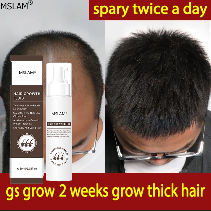 MSLAM spray Hair oil Hair tonic Hair growth essence Essential oils for hair  growth Hair growth spray Hair growth cream Natural ginger extract prevents hair  loss and promotes hair growth Nourish hair
