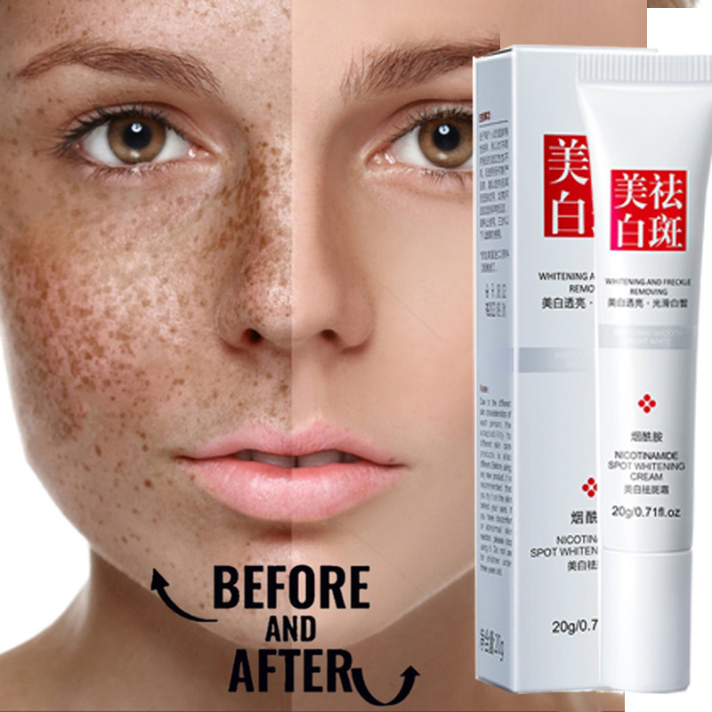 whitening-freckle-dark-spot-remover-melasma-removal-cream-original