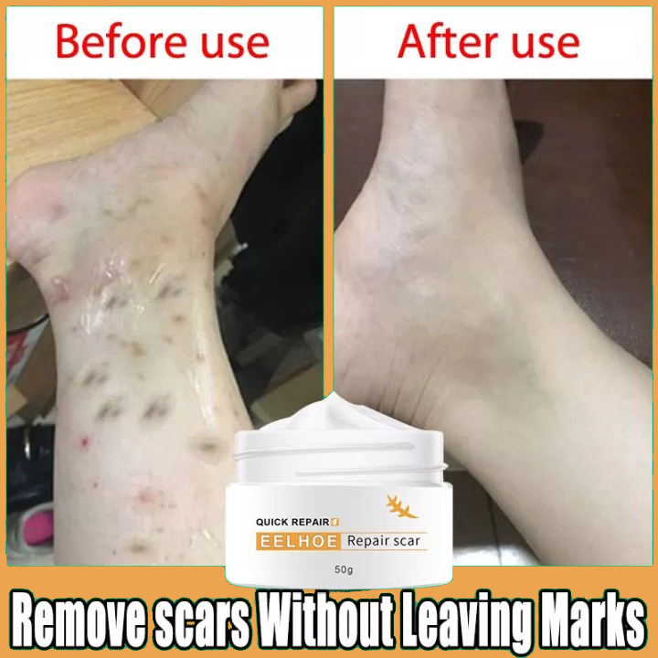 Eelhoe Original Scar Removal Cream Scar Remover For Old Scar On Leg Stretch Mark Remover Peklat 1244