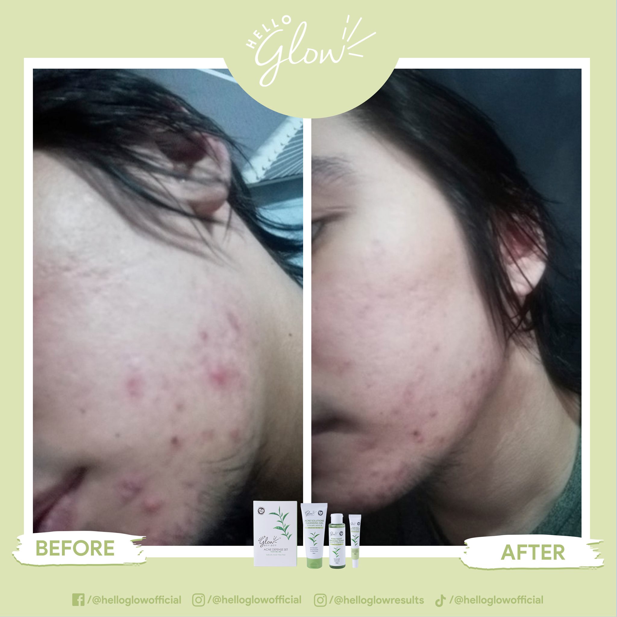 hello glow acne defense set