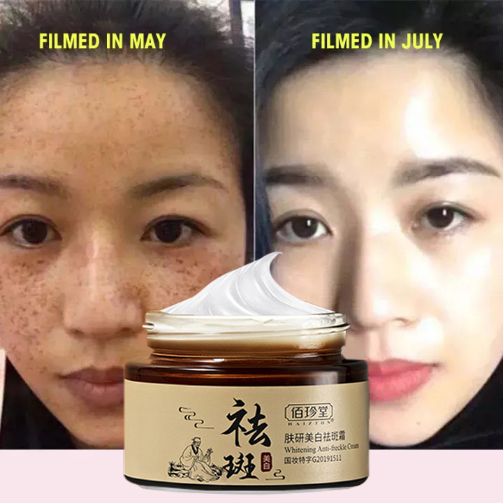 30g Whitening melasma cream original pekas cream eraser original japan Anti Aging Serum Pekas