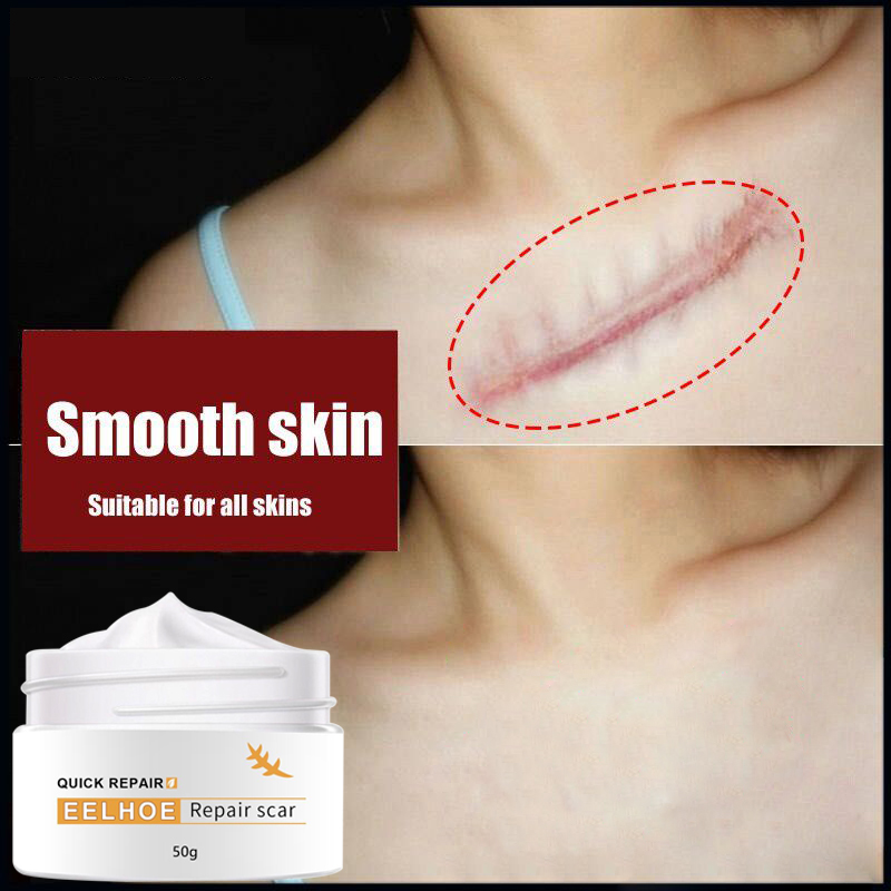 Scar Repair Cream Scar Remover For Old Scar On Legs Pimple Marks