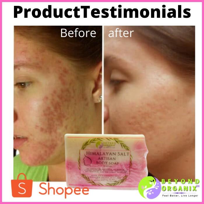 Pure Pink Himalayan Artisan Soap (Anti-Acne Pimple Breakout Natural ...