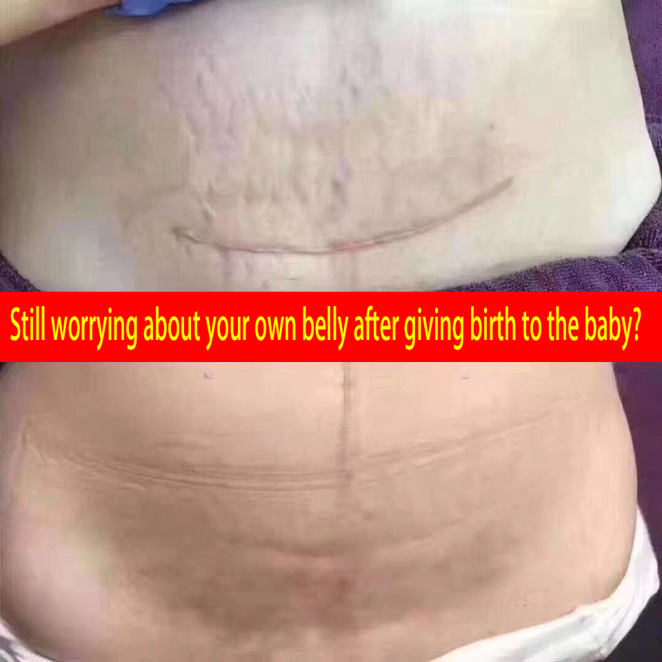 scar and keloid remover , keloid scar remover original , keloids removal original cream , keloid