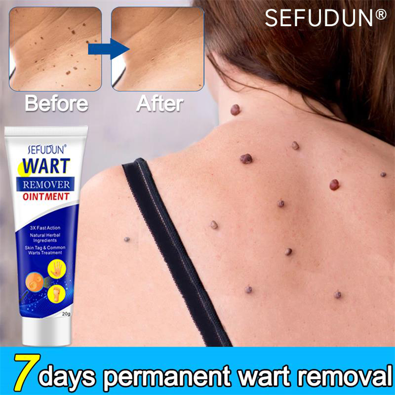 SEFUDUN Original Painless wart remover cream Mole remover No residue