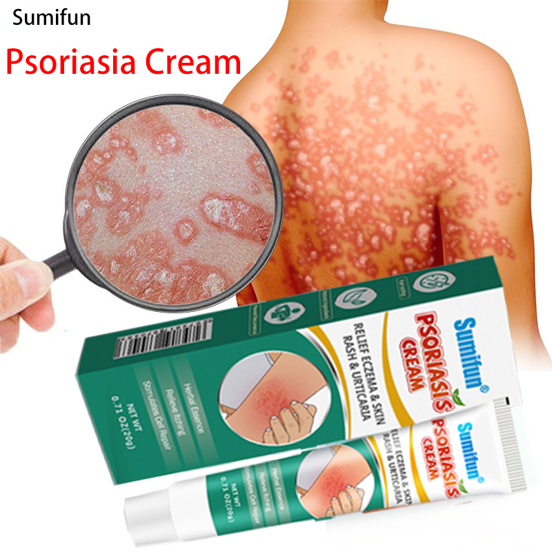 Solution for Psoriasis Eczema herbal antibacterial cream 15g Safe Plant ...
