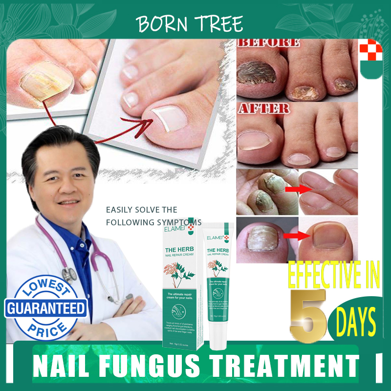 nail treatment fungal anti fungal for nails repair treatment cream gel