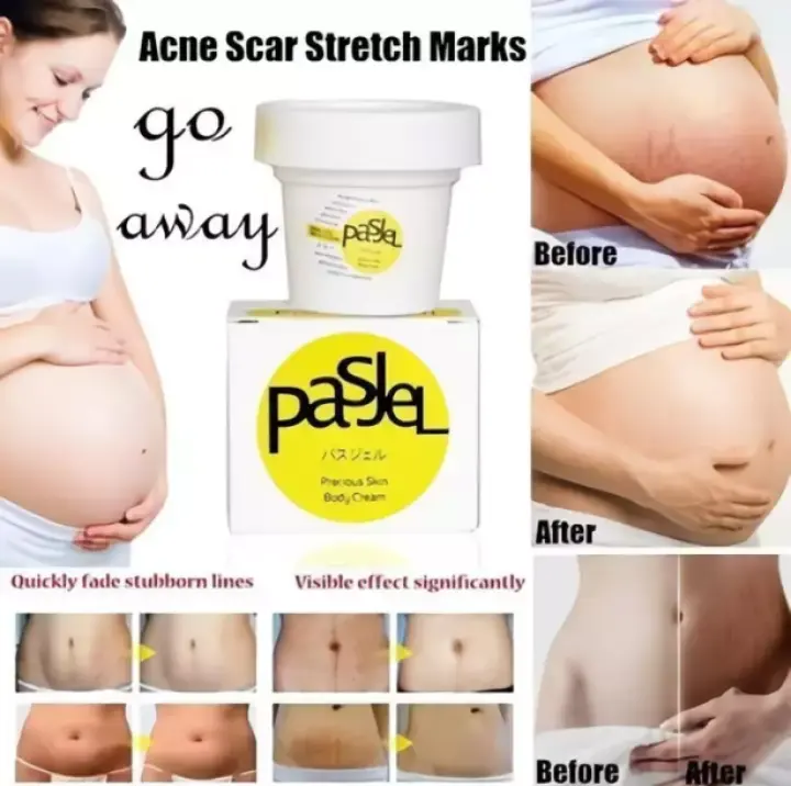pasjel stretch mark removal